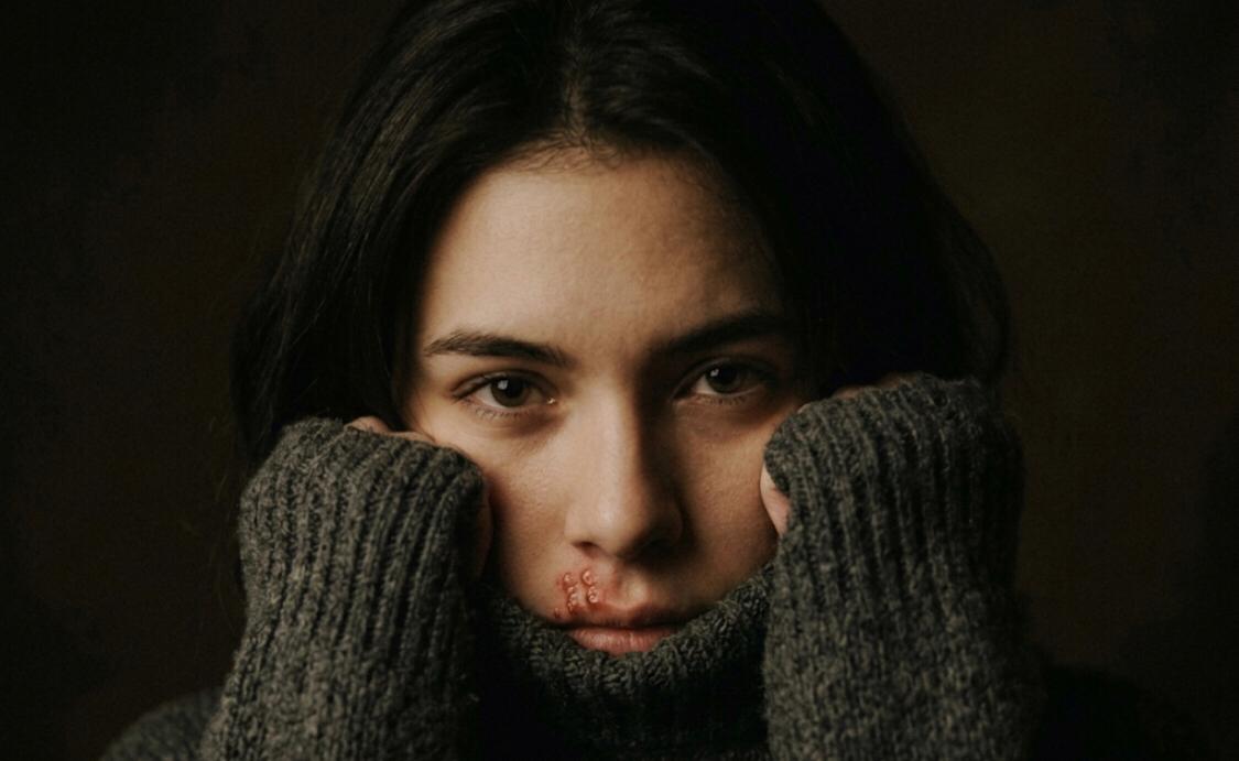 A young woman with dark hair and brown eyes in a moody portrait pulls a grey turtleneck sweater up to her face. Active cold sore lesions (herpes simplex virus) are visible on her upper lip.